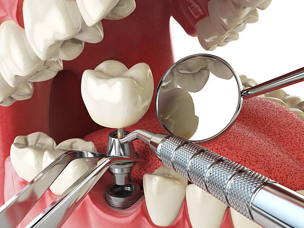 Best Emergency Wisdom Tooth Extraction in Carterville, MO